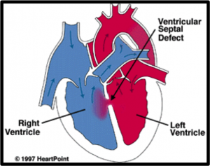 ventricular septal defect